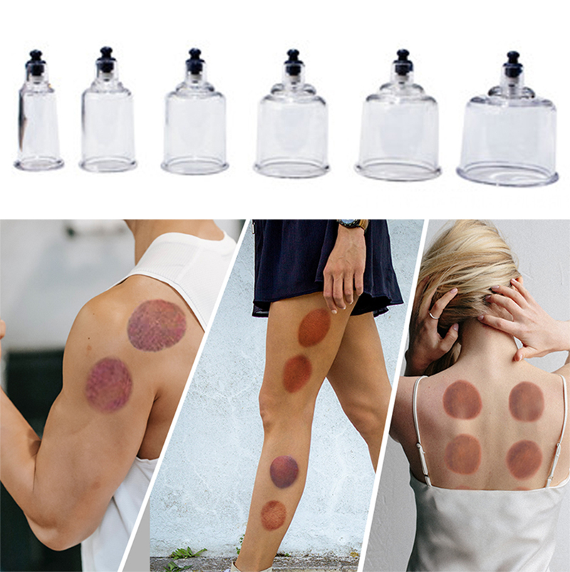 17cans Cupping Therapy Set Ven - Cupping Therapy Set ulasan dan harga