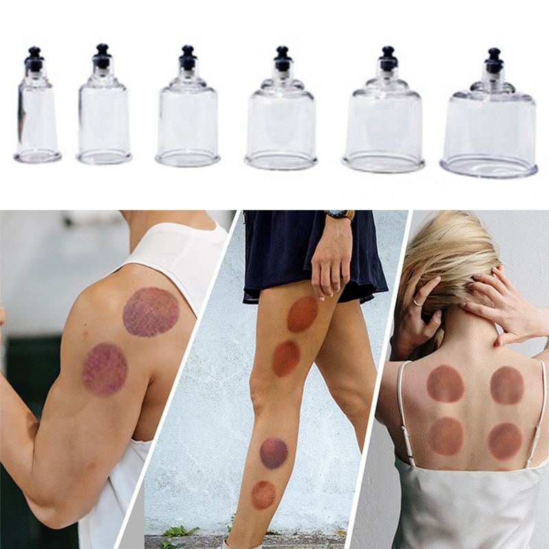 17 Cans Vacuum Cupping Therapy - Cupping Therapy Set ulasan dan harga